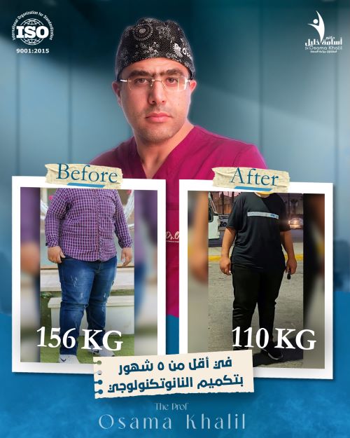 صور قبل و بعد التكميم